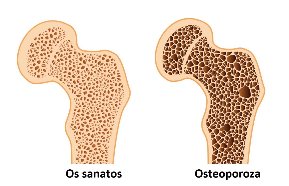 intrebari frecvente tratament osteoporoza